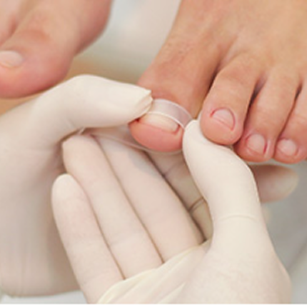 Unha encravada com órtese